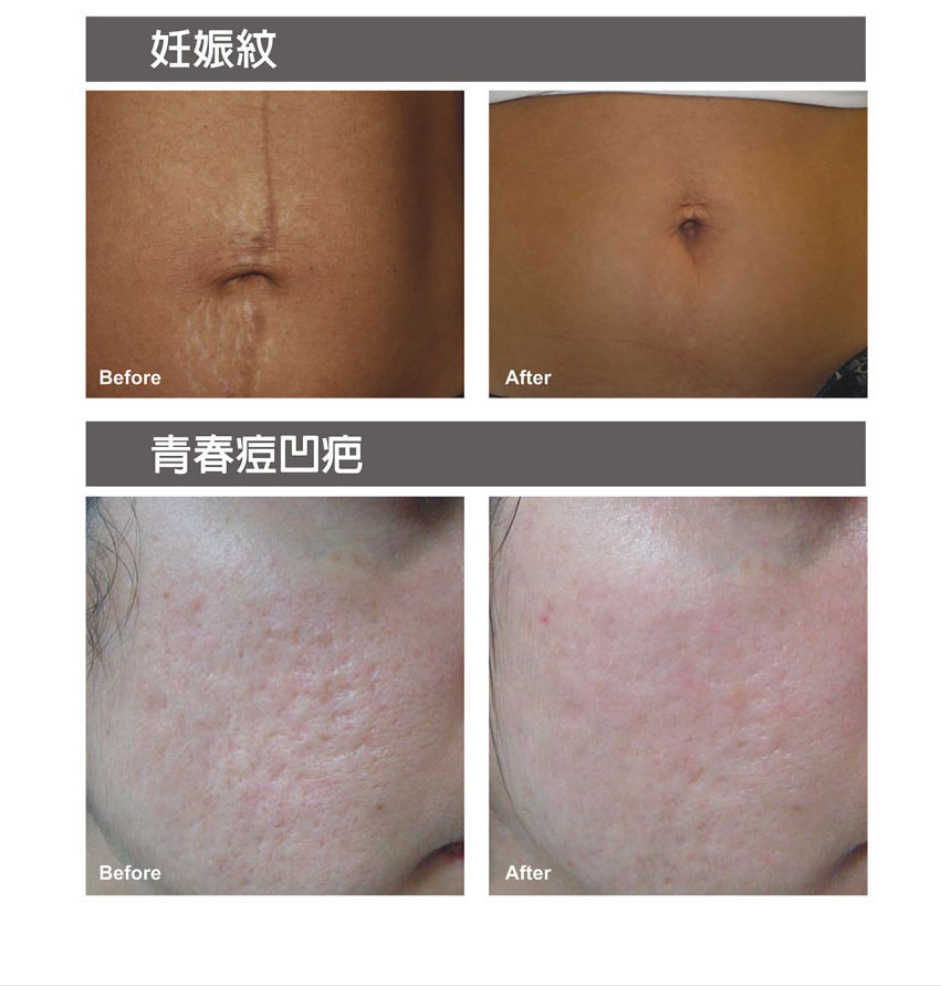 電漿飛梭的應用