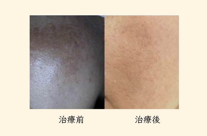 皮秒雷射治療前後對比圖1