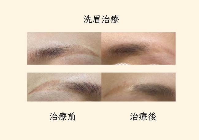 皮秒雷射治療前後對比圖2