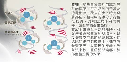 Alma聚焦電波療程的優勢