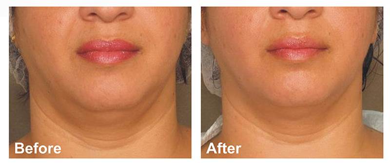 Alma聚焦電波療程的案例照片