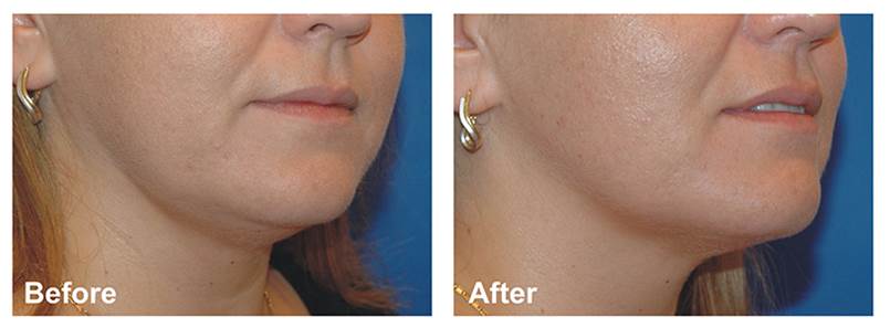 Alma聚焦電波療程的案例照片