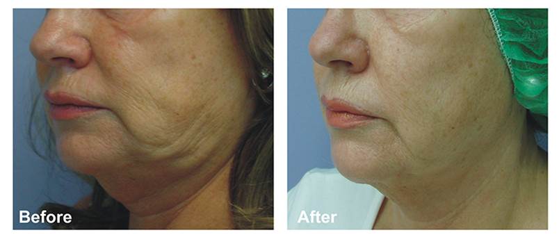 Alma聚焦電波療程的案例照片