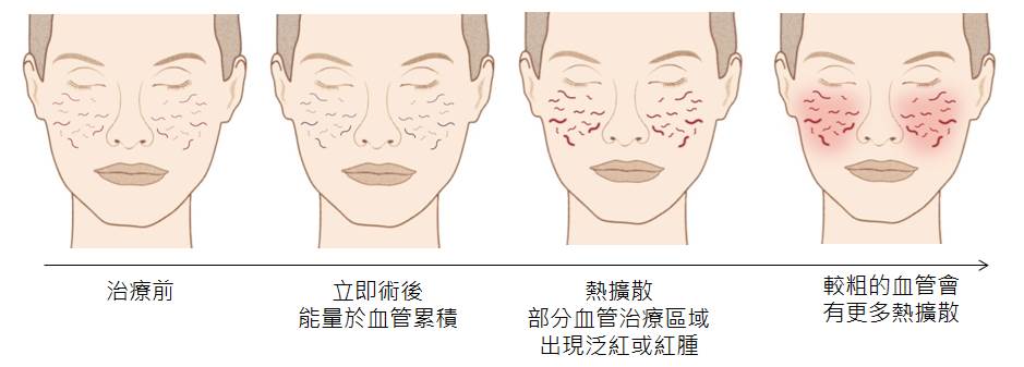 Nordlys魔幻極光血管絲雷射專利冷卻系統