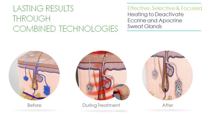 電波技術如何治療多汗症?