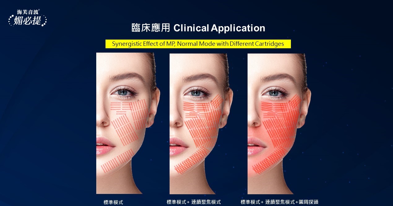 ULTRAFORMER MPT探頭作用及適用部位圖示三。