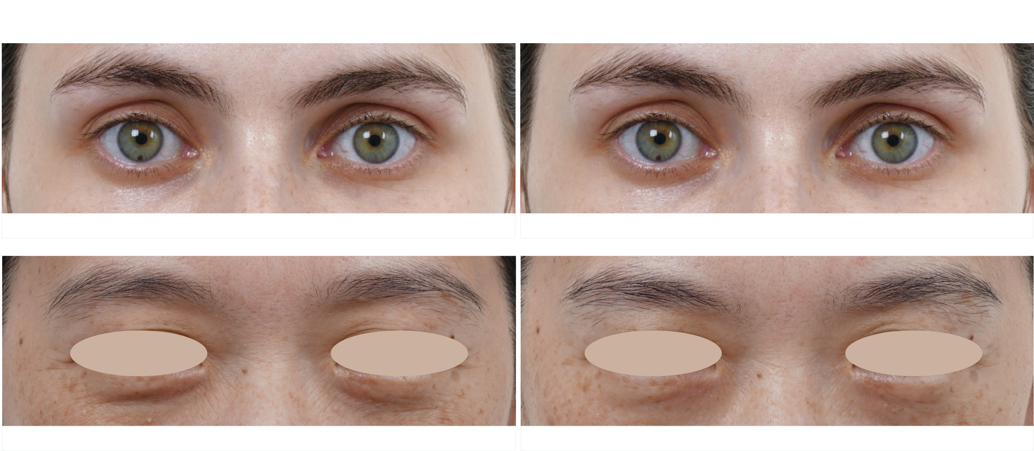 海芙音波媚必提眼周治療案例