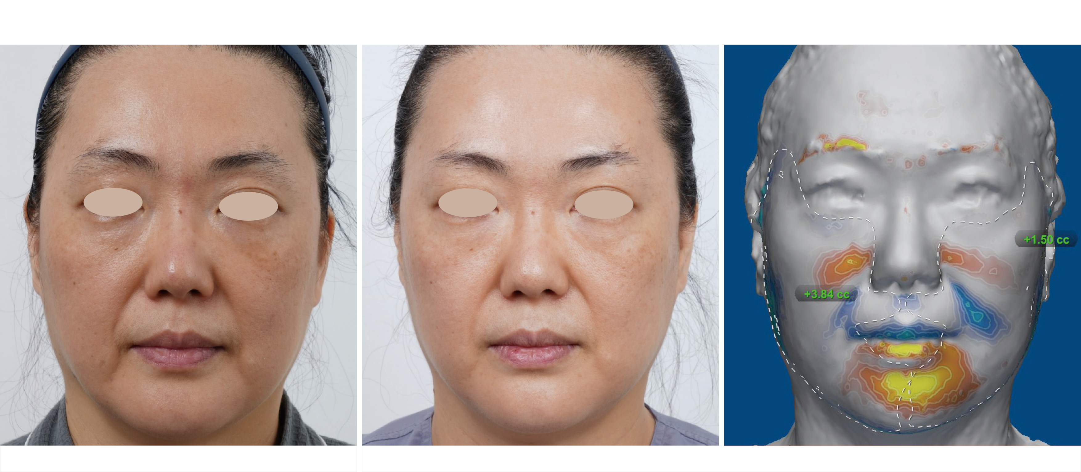 海芙音波媚必提全臉治療案例