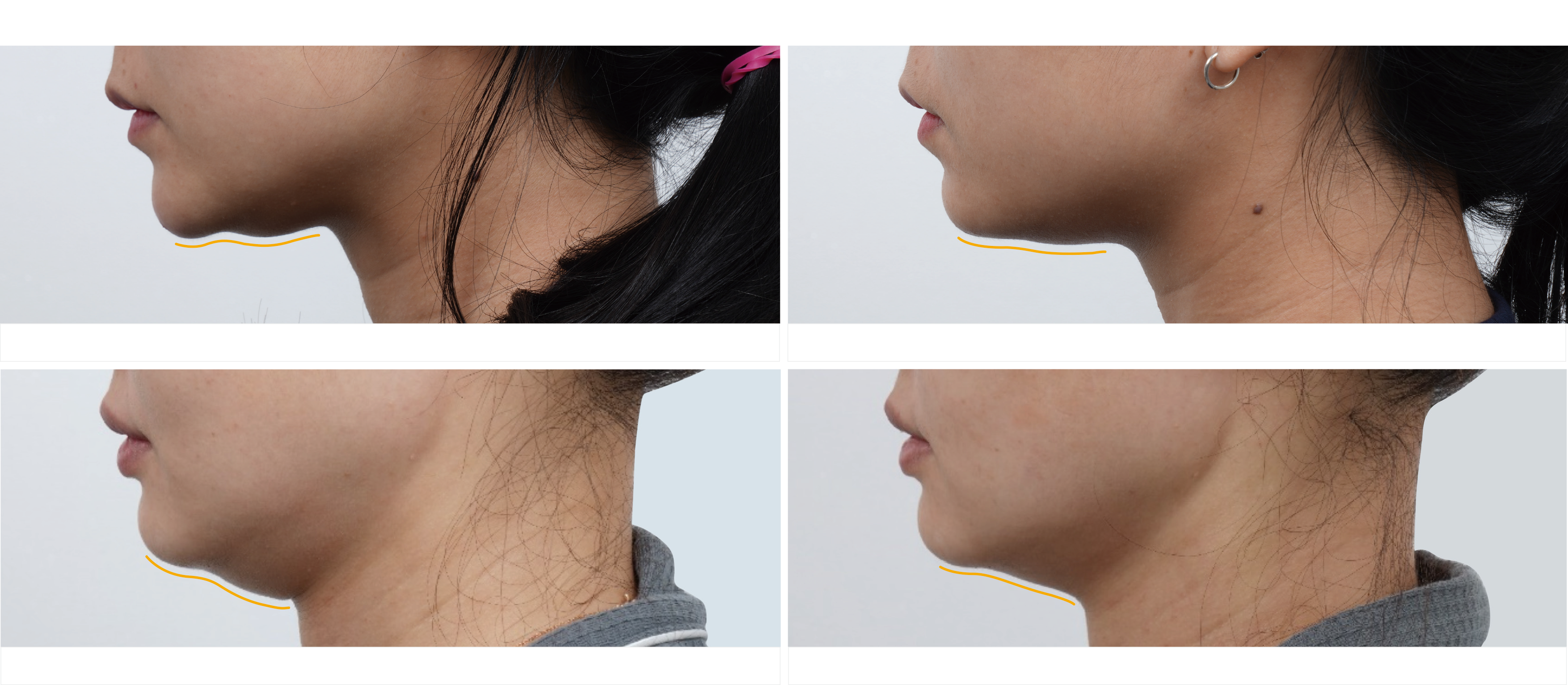 海芙音波媚必提雙下巴治療案例