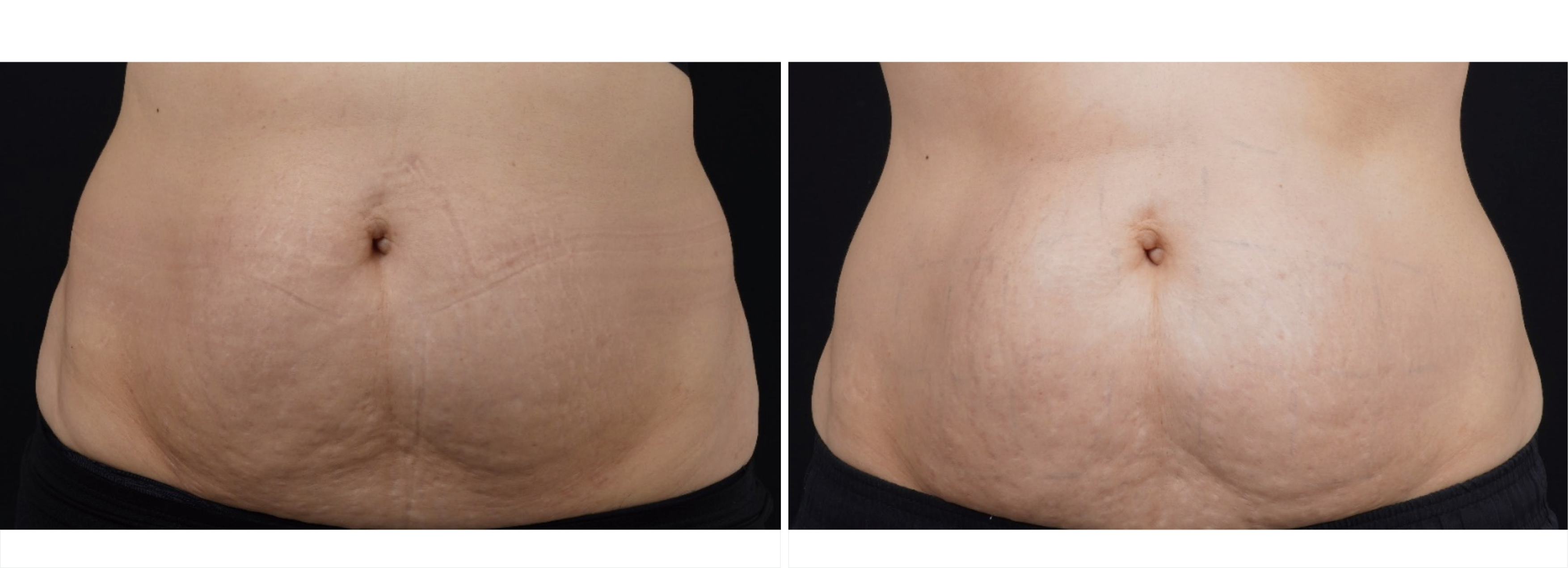 海芙音波媚必提腹部治療案例