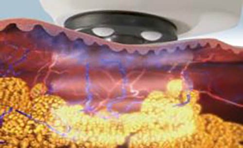 Alma電波拉提案例2