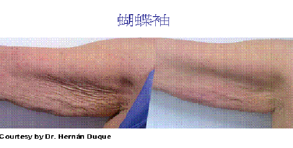 四次電波治療後的手臂