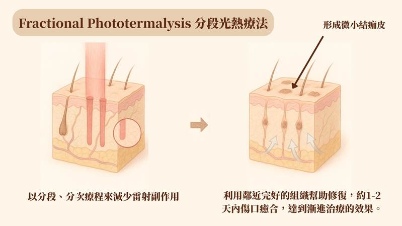 Nordlys魔幻極光飛梭治療示意圖