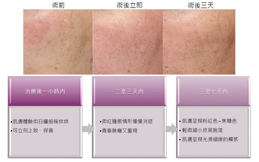 Nordlys魔幻極光飛梭治療過程圖片