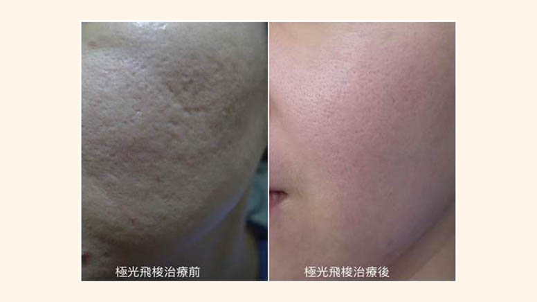 Nordlys魔幻極光飛梭案例照片