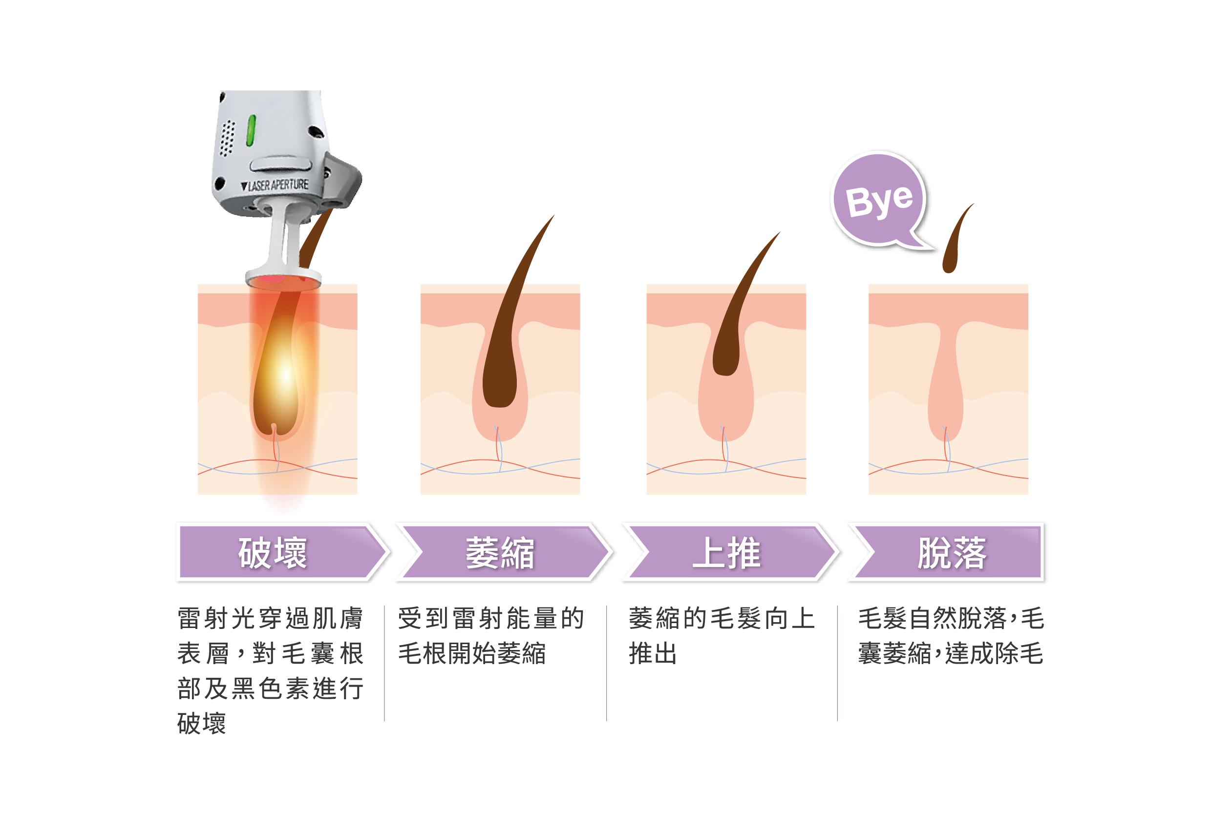 亞歷山大除毛雷射原理示意動畫
