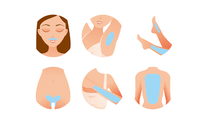 亞歷山大雷射適用部位示意圖