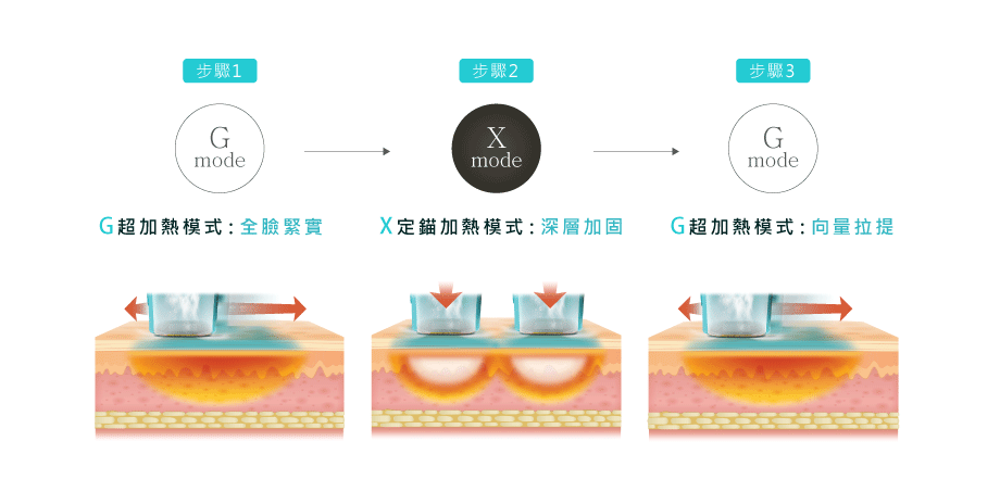插圖展示GXG超玩美模式的治療過程,圖中以設備圖示和中文文字說明各步驟,背景為明亮診所環境,整體氛圍專業且安心